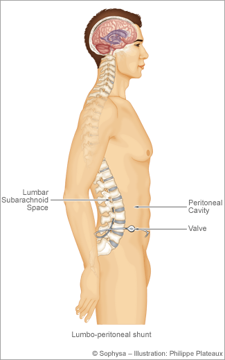 Adult board discussion hydrocephalus