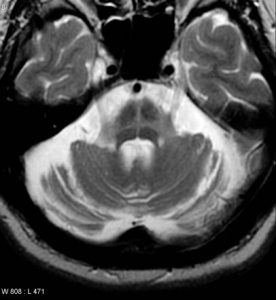 Multiple System Atrophy Resulting in Hot-cross bun