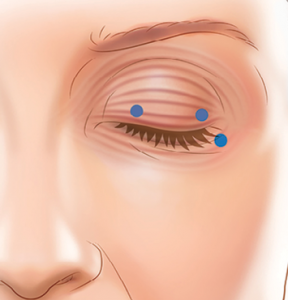 Blepharospasm