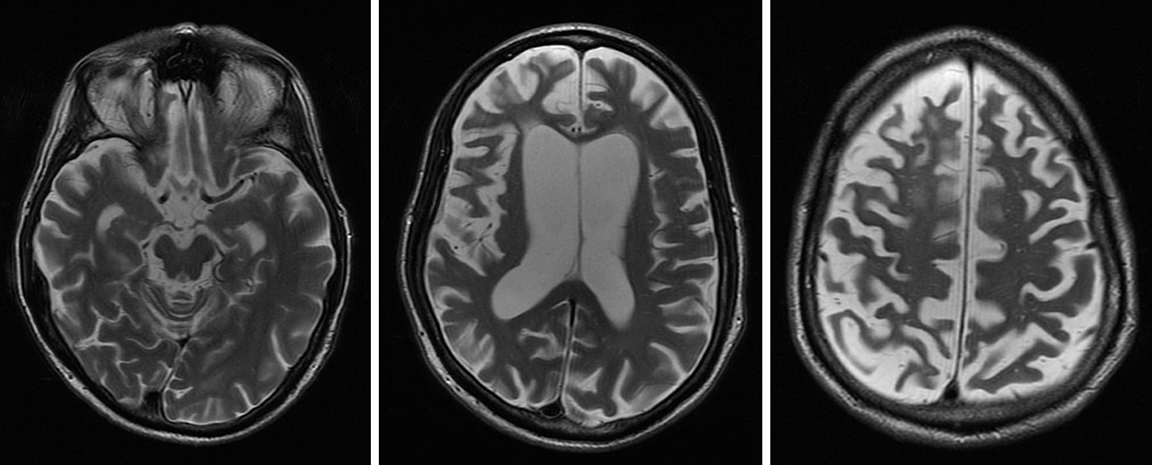 corticobasal degeneration