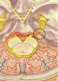 Trigeminal Neuralgia figure 2
