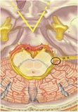 Glossopharyngeal neuralgia 02