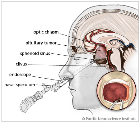 acromegaly endoscopic endonasal surgery