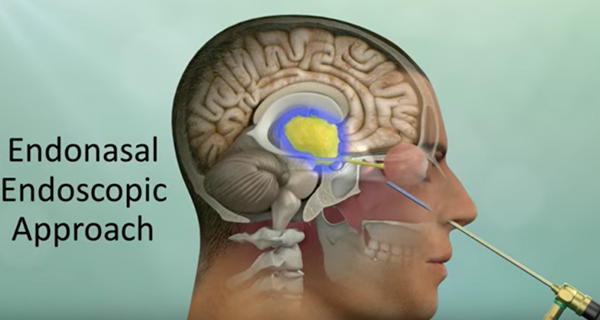 Endoscopic Endonasal Craniopharyngioma Surgery