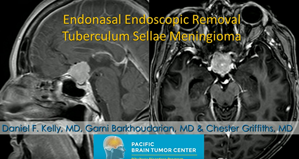 Endoscopic Endonasal Meningioma Surgery
