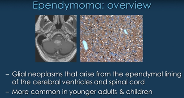 Ependymoma-in-the-4th-Ventricle