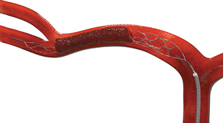Stryker-Trevo Stent Retreiver