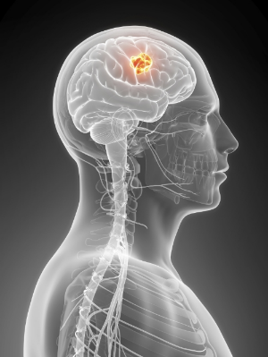 Glioblastoma-(c)GlioNova