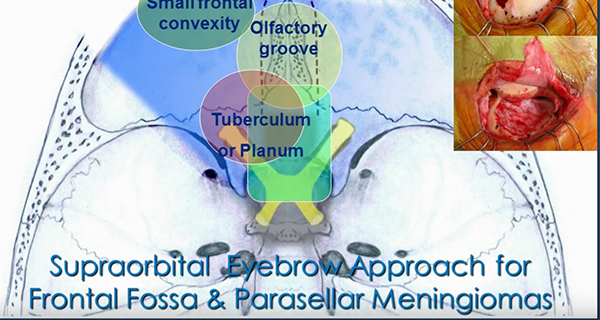 Meningioma-Minimally-Invasive-Keyhole-Endoscopic-Surgery