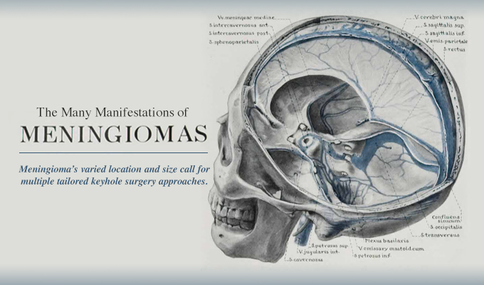 the many manifestations of meningiomas pacific neuroscience institute