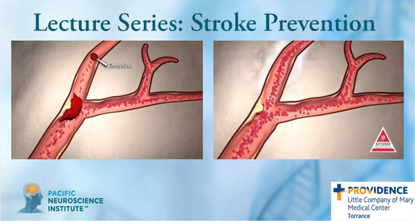 Stroke Prevention