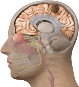 brain tumor