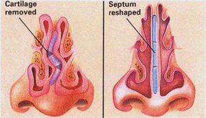 deviated septum