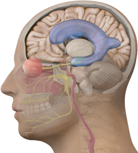 hydrocephalus