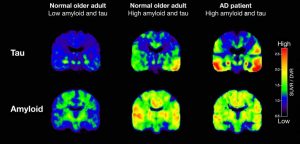 myloid and Tau Imaging