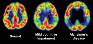 PET neuroimaging Alzheimer's