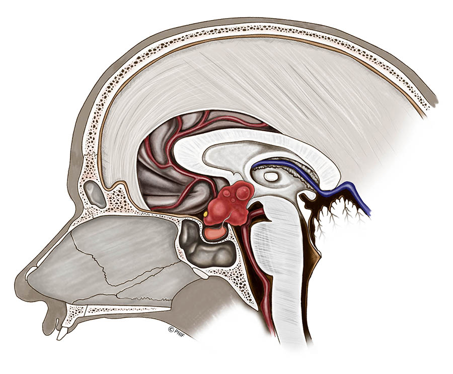 Endoscopic Craniophary...