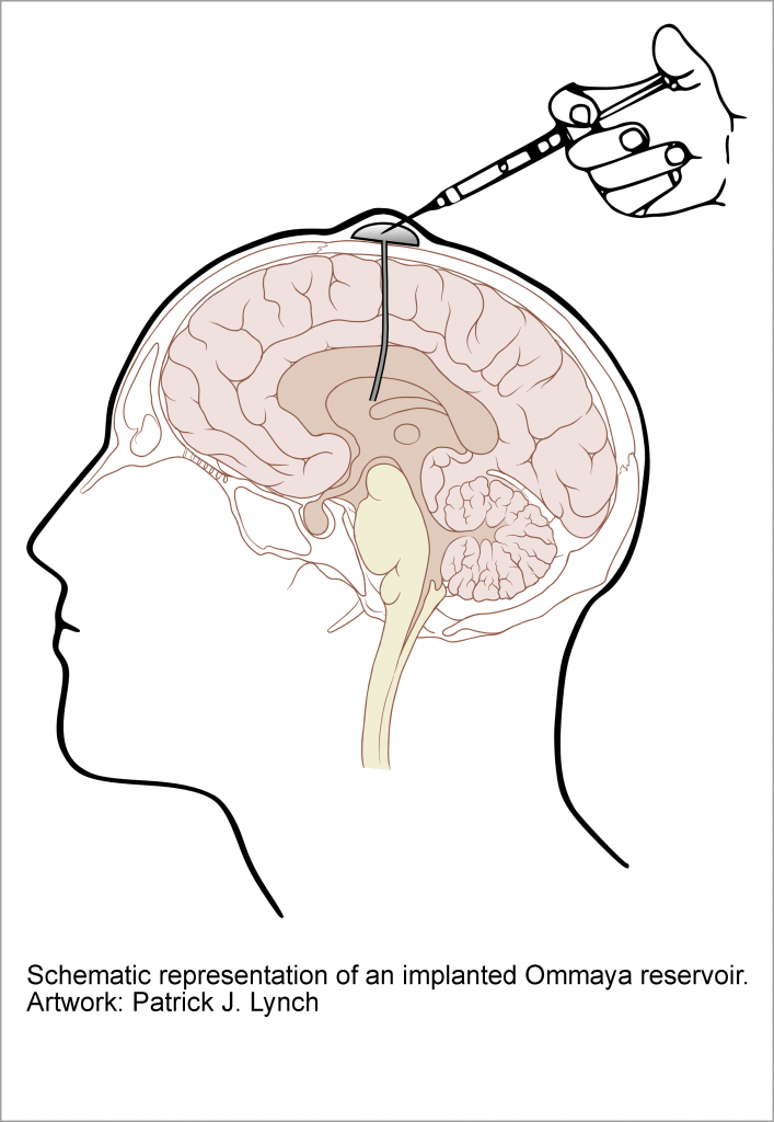 Ventricular Reservoir Placement Adult Hydrocephalus Center