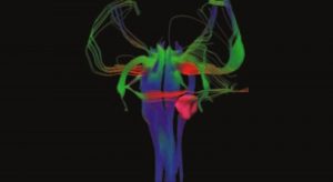 Cavernoma Institute PNI