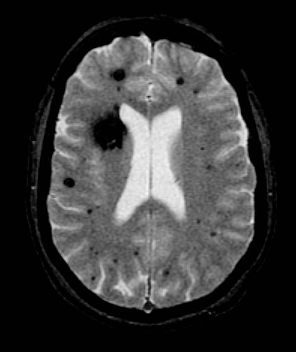 Cavernoma Stroke & Aneurysm Center
