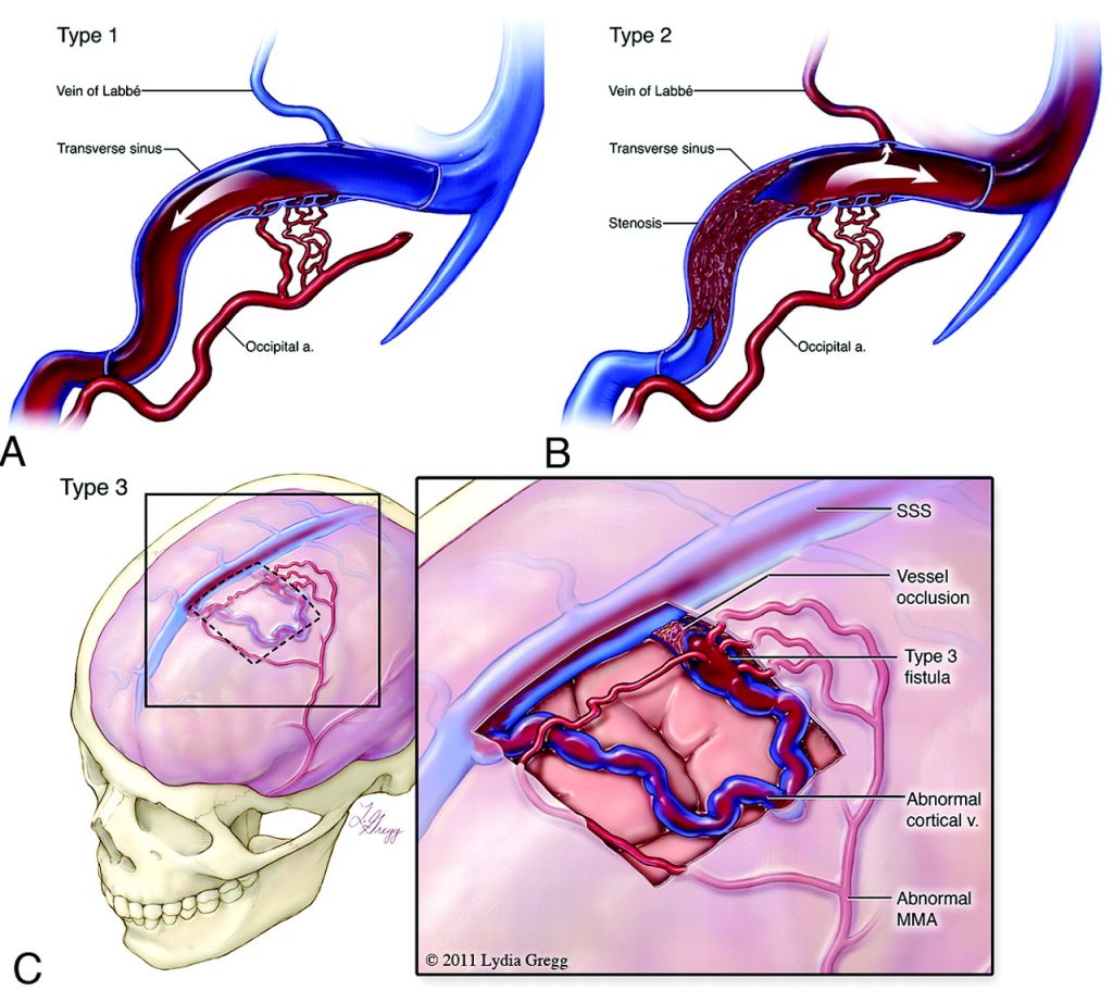Dural arteriovenous fistula (DAVF)