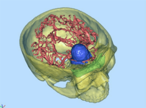 Skull base tumor displayed in 3D software