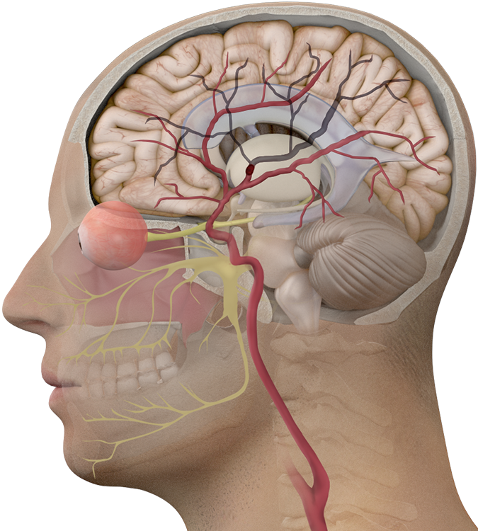 stroke