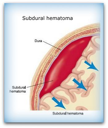 Diagram of a subdural hematoma.
