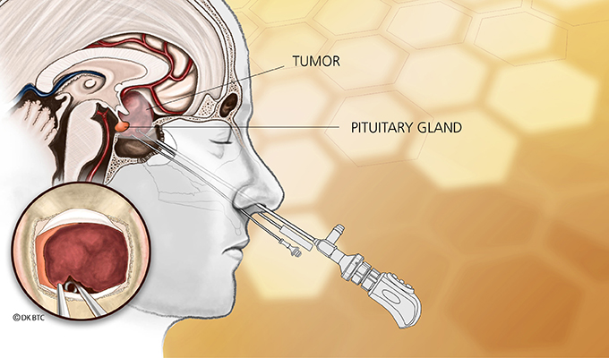 endonasal procedure illustration