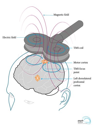 Transcranial magnetic stimulation TMS