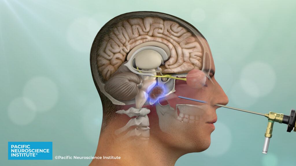 Endoscopic endonasal surgery for Clival Cordoma