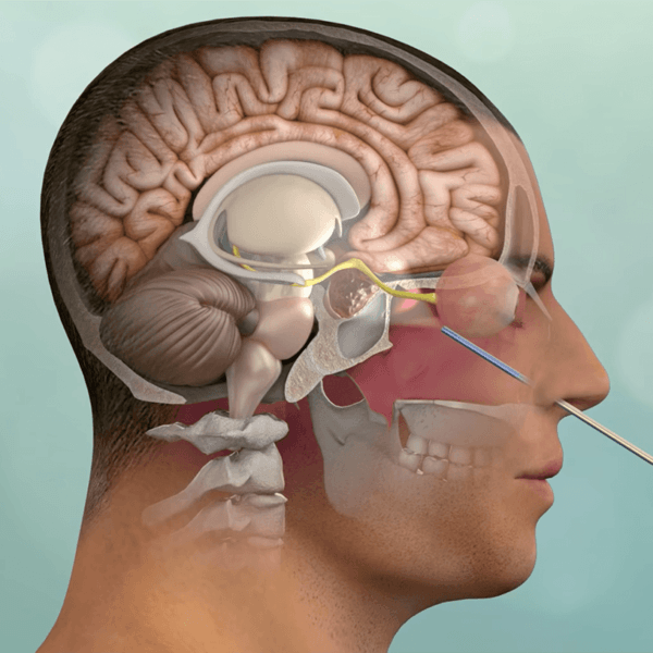 illustration of a procedure via the nasal passage