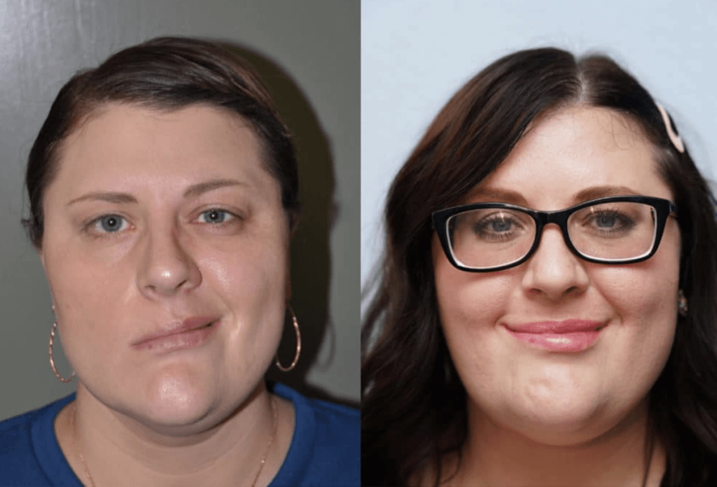 Facial Reanimation Surgery Pacific Eye & Ear