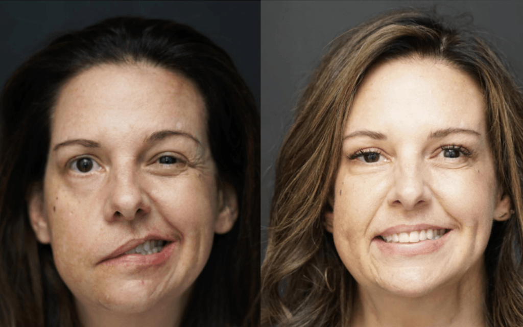 Facial Reanimation Surgery Pacific Eye & Ear