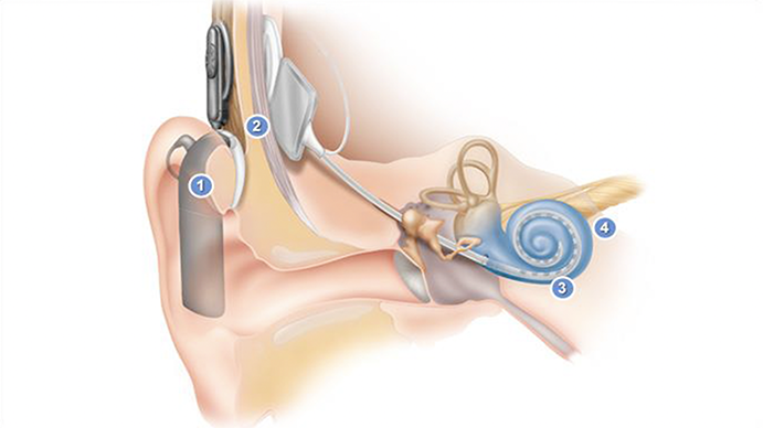 Cochlear implant