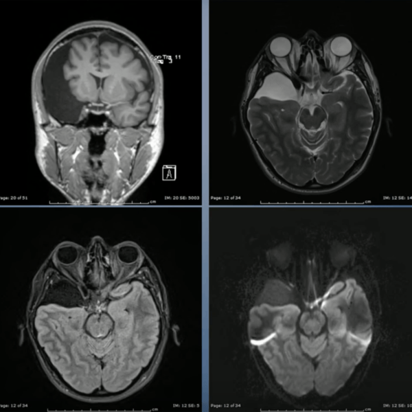 four scans of a brain