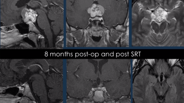 8 months post-op and post SRT
