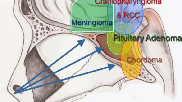 rendering of a pituitary adenoma