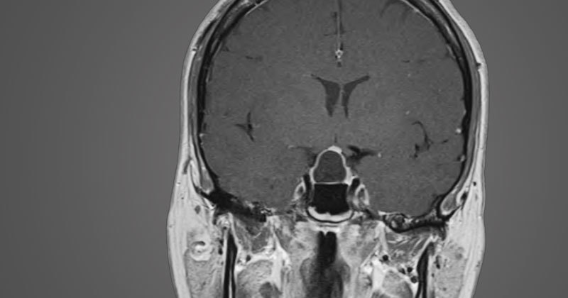 arachnoid cyst imaging