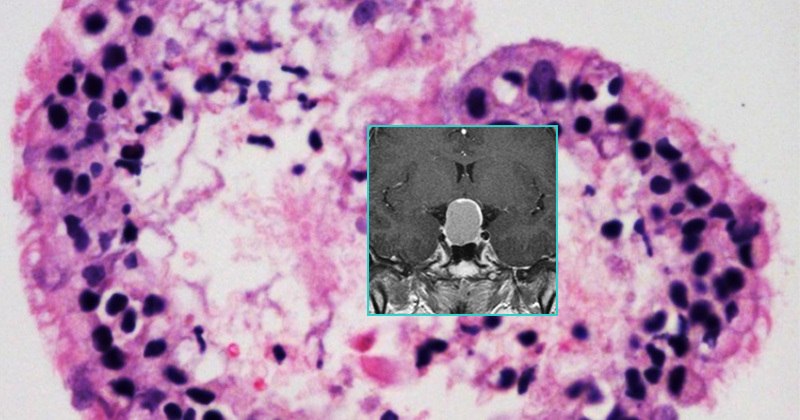 Cleft cyst imaging