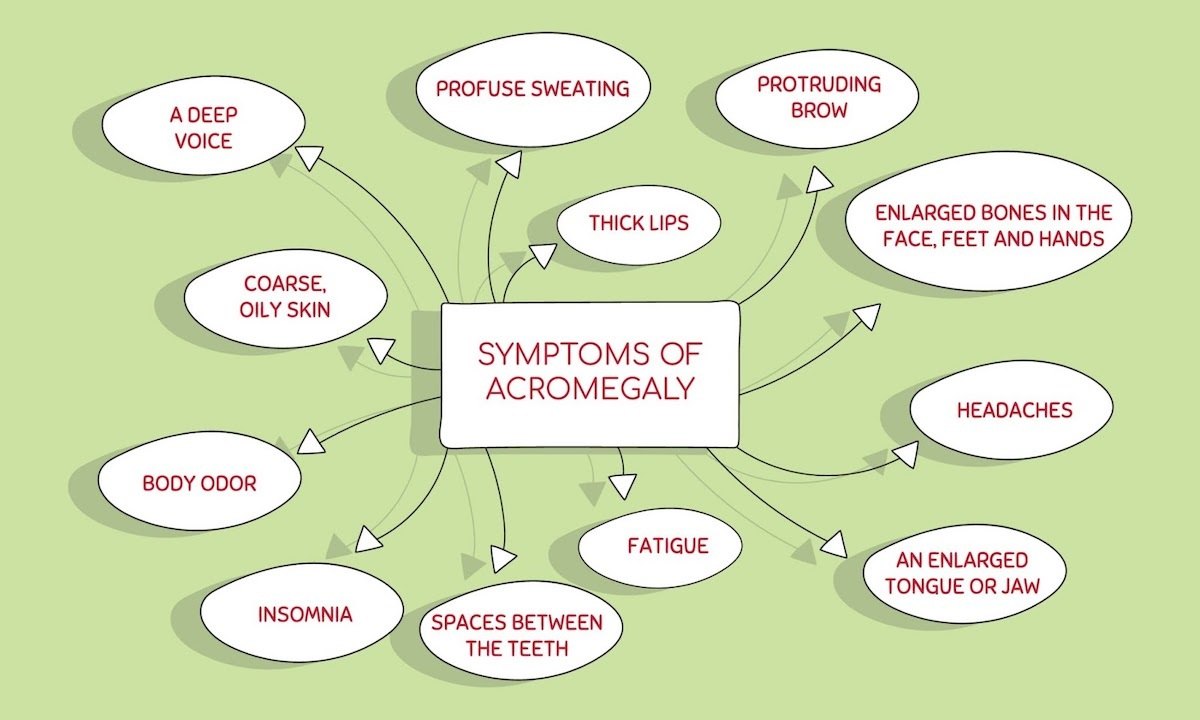Symptoms Of Acromegaly