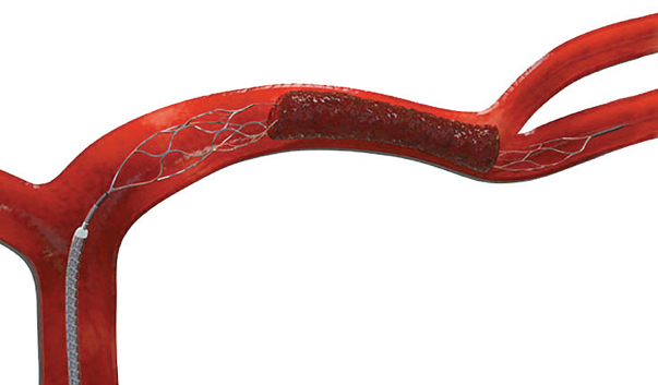 Carotid Artery Stent retriever
