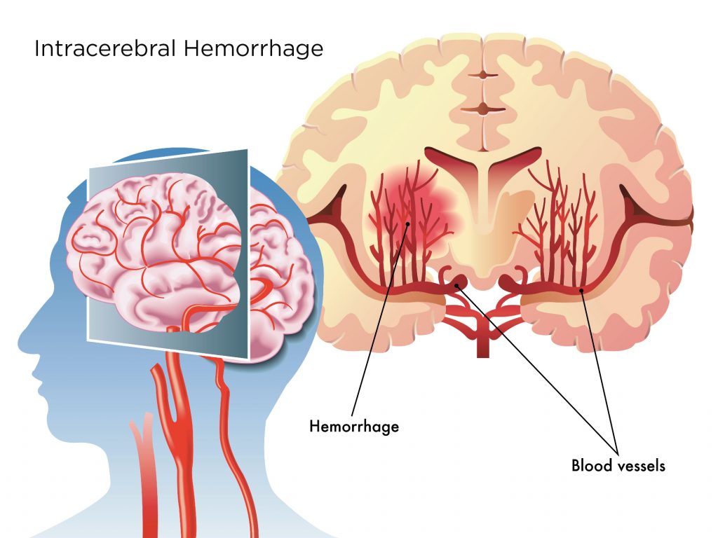 Intracerebral Hemorrhage Symptoms & Treatment | Pacific Stroke