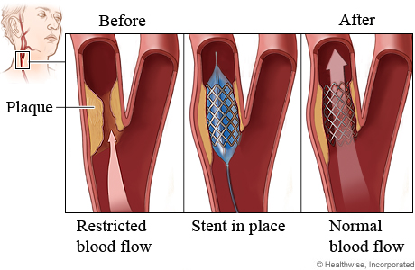 carotid artery stenting
