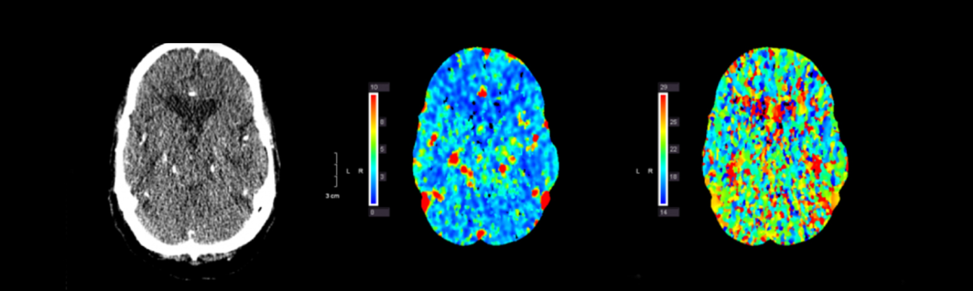 Subarachnoid Hemorrhage Symptoms & Treatment