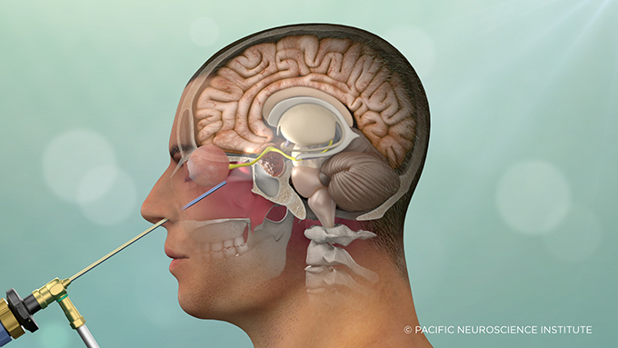 endoscopic endonasal keyhole pituitary surgery (c) PNI