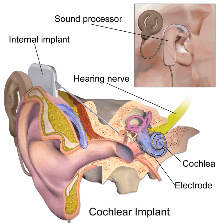 Cochlear Implant Program Gives the Gift of Hearing | Pacific ...