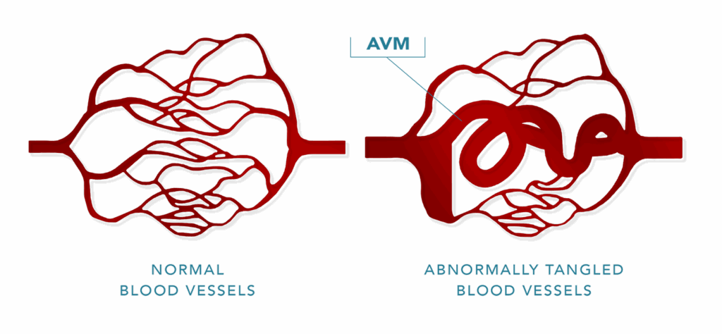 Arteriovenous Malformation (AVM)