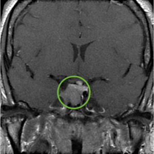 Acromegaly diagnosis MRI