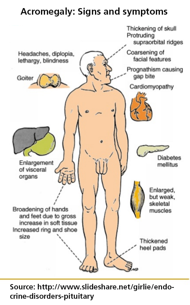 Acromegaly treatment for signs and symptoms